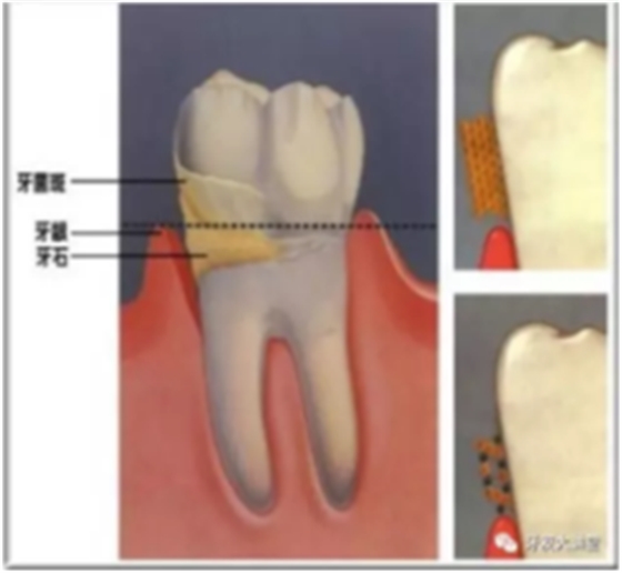牙周炎，中国成年人后半生永远的 痛 ！