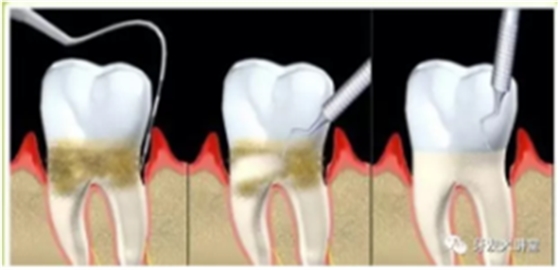 牙周炎，中国成年人后半生永远的 痛 ！