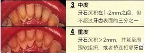 牙周炎，中国成年人后半生永远的 痛 ！