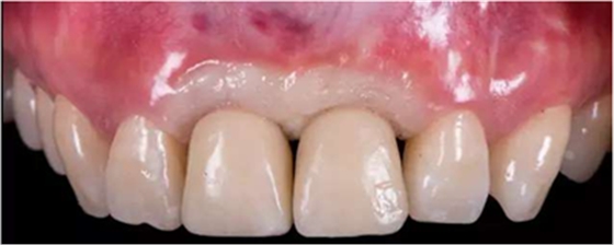 Asc全瓷角度基台一体冠进行种植前牙美学修复一例