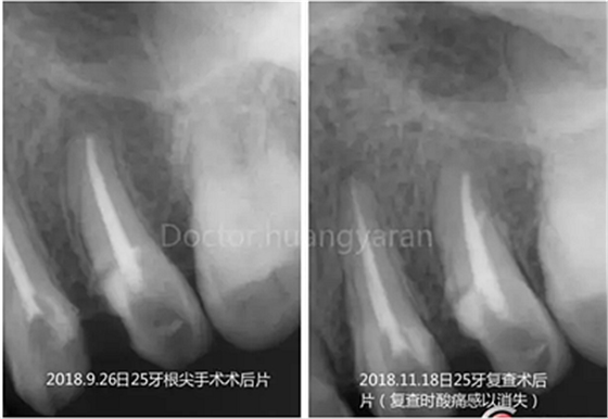 当根管治疗遇见根尖骨穿孔