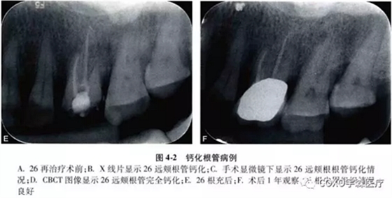 （六期）细小钙化根管的疏通——病因及诊断