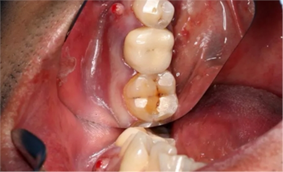 病例分享|下颌后牙牙槽嵴保存延期种植颊侧骨壁吸收植骨引导骨再生一例 病例分享|下颌后牙牙槽嵴保存延期种植颊侧骨壁吸收植骨引导骨再生一例