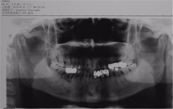 病例分享|下颌后牙牙槽嵴保存延期种植颊侧骨壁吸收植骨引导骨再生一例 病例分享|下颌后牙牙槽嵴保存延期种植颊侧骨壁吸收植骨引导骨再生一例