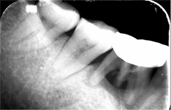 病例分享|下颌后牙牙槽嵴保存延期种植颊侧骨壁吸收植骨引导骨再生一例 病例分享|下颌后牙牙槽嵴保存延期种植颊侧骨壁吸收植骨引导骨再生一例