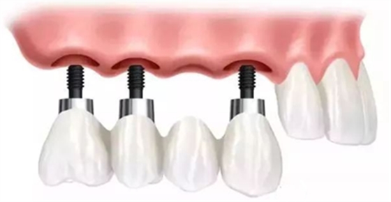 延长种植牙使用寿命的方法