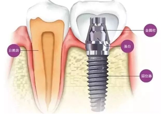 延长种植牙使用寿命的方法