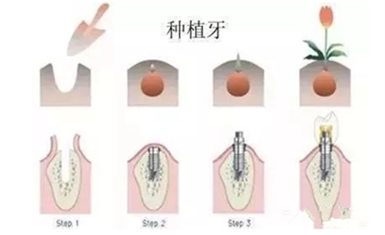 延长种植牙使用寿命的方法