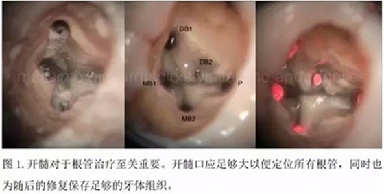 【病例分享】根管冠部预敞