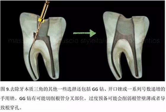 【病例分享】根管冠部预敞