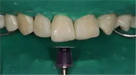 病例分享｜复合树脂微创美学修复关闭上前牙间隙