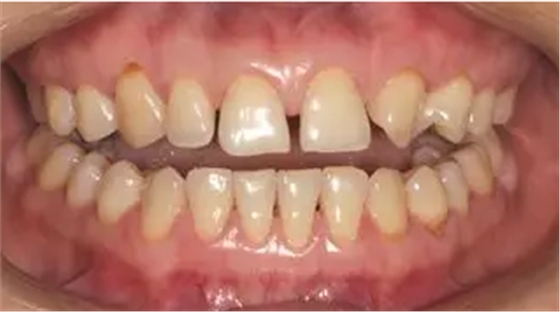 病例分享｜复合树脂微创美学修复关闭上前牙间隙
