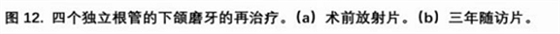 宇森SC-Pro镍钛根管锉|宇森医疗根管治疗器械领跑者