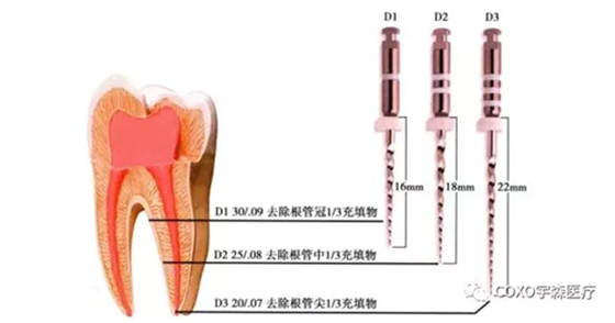 	（十一期）根管充填物的清理-牙胶的去除