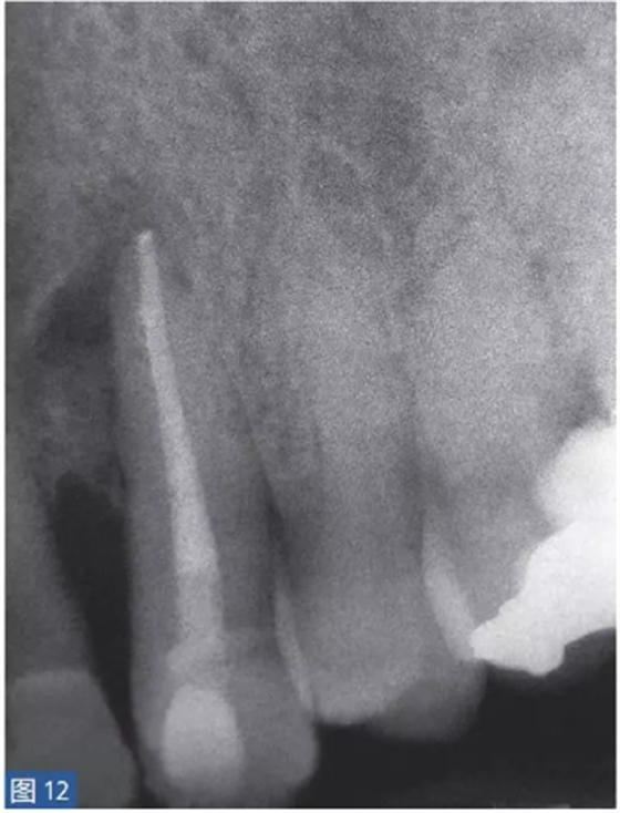 根尖周炎的病因与症状