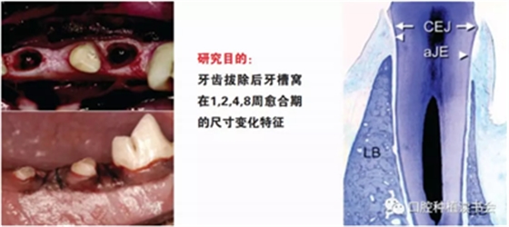 血液衍生物PRF&CGF在牙槽窝处理中的应用