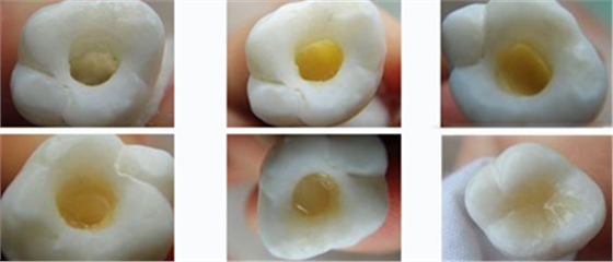 各类洞形的树脂充填方法