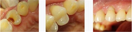 各类洞形的树脂充填方法