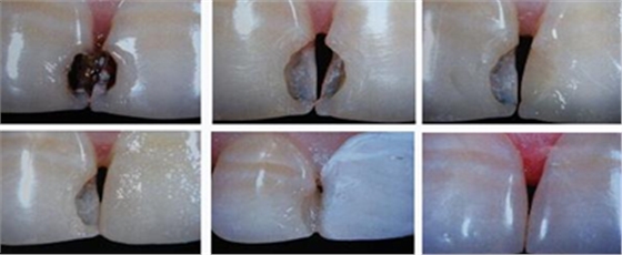 各类洞形的树脂充填方法