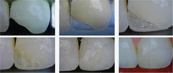 各类洞形的树脂充填方法
