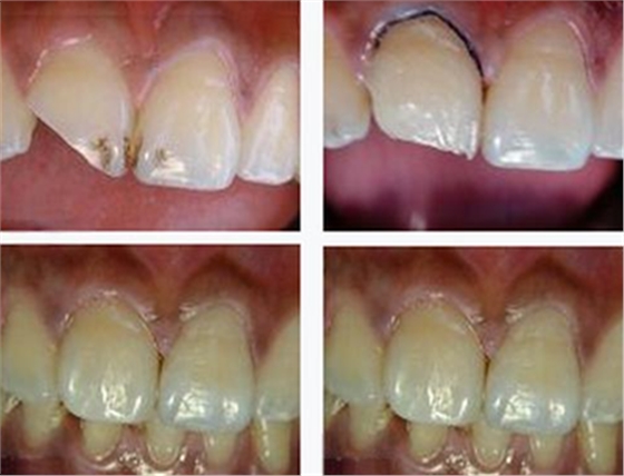 各类洞形的树脂充填方法