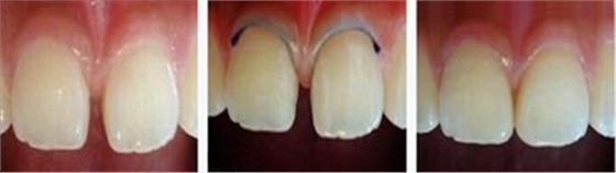 各类洞形的树脂充填方法