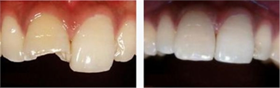 各类洞形的树脂充填方法