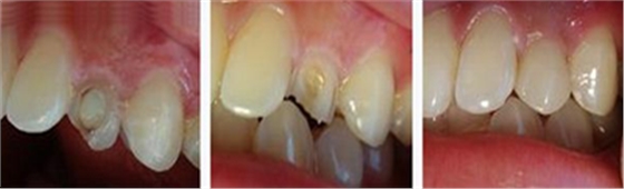 各类洞形的树脂充填方法