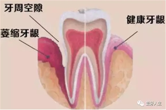 牙龈萎缩怎么办？