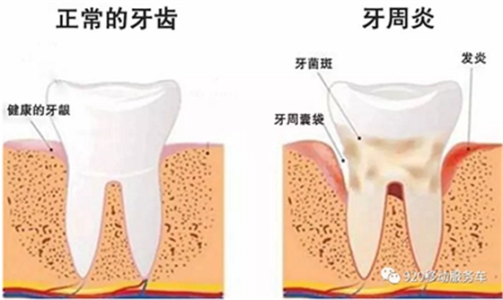 牙龈萎缩怎么办？