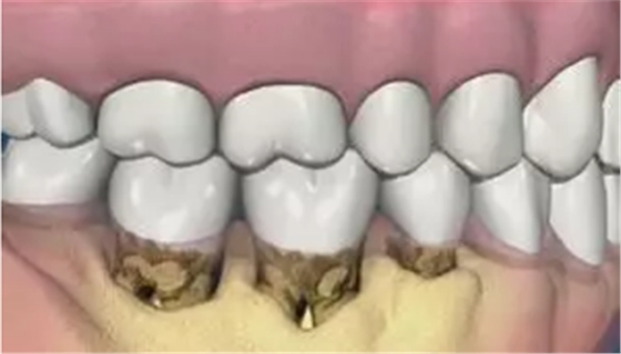牙龈萎缩怎么办？