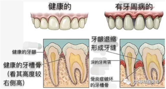 牙龈萎缩怎么办？