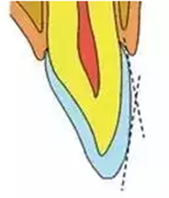 贴面备牙知多少? 贴面备牙知多少?