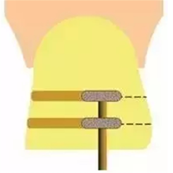 贴面备牙知多少? 贴面备牙知多少?