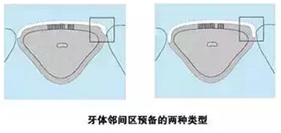 贴面备牙知多少? 贴面备牙知多少?