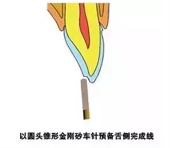 贴面备牙知多少? 贴面备牙知多少?