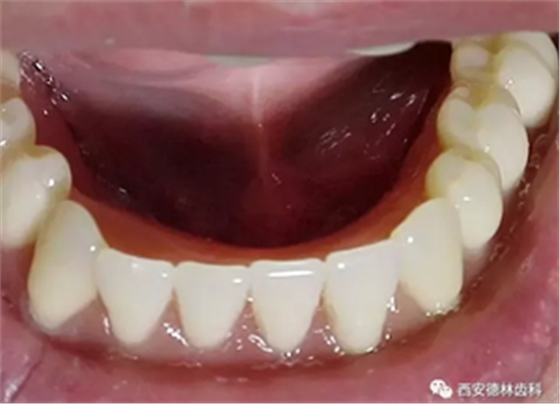 如何做好全口义齿？
