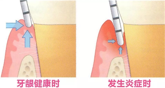 牙周探诊SRP