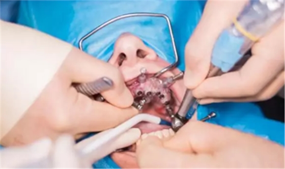 种植体与神经管的「相爱相杀」