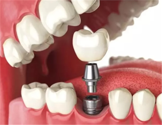 种植体与神经管的「相爱相杀」
