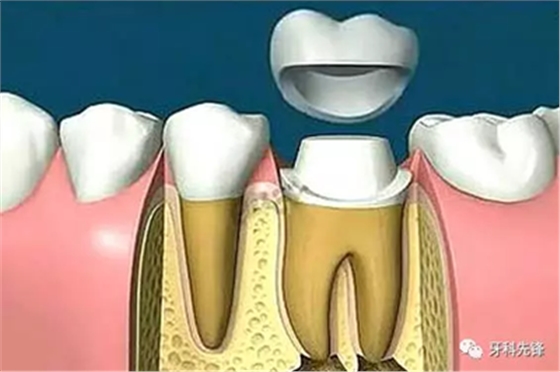 补牙不做冠，疗效少一半！根管治疗后牙齿已经不疼了，为什么还要戴牙冠呢？