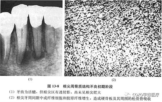 根尖周牙骨质结构不良初期阶段
