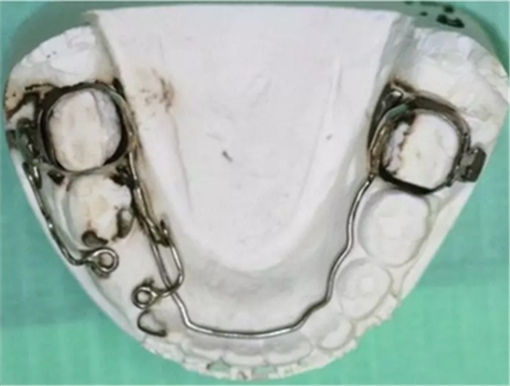 正畸文献赏析--埋伏/阻生尖牙的正畸治疗