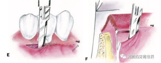 FGG游离牙龈移植在历史上的各种改良以及发展前景