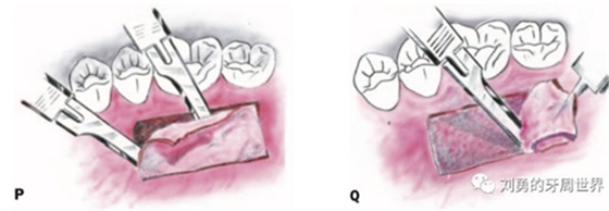 FGG游离牙龈移植在历史上的各种改良以及发展前景