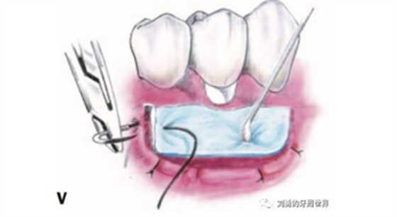 FGG游离牙龈移植在历史上的各种改良以及发展前景