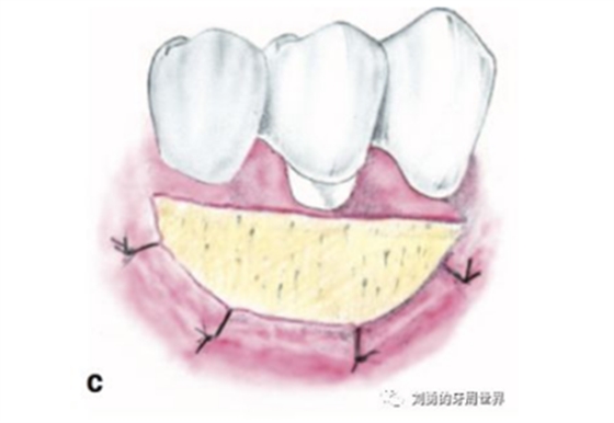 FGG游离牙龈移植在历史上的各种改良以及发展前景