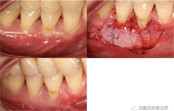 FGG游离牙龈移植在历史上的各种改良以及发展前景