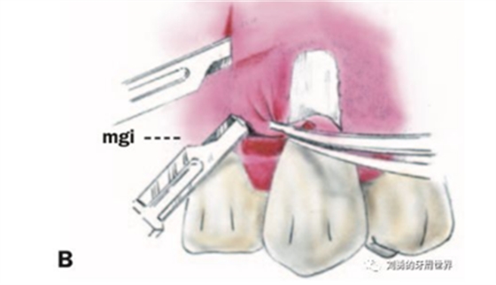 FGG游离牙龈移植在历史上的各种改良以及发展前景