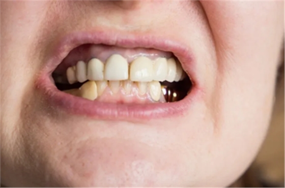 牙龈变色了？牙医该如何观色识病因